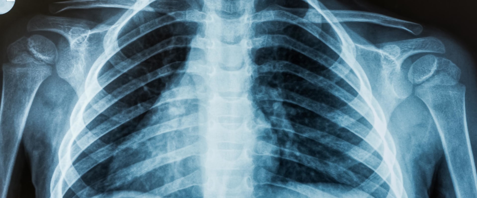 Types of Radiation Used in Medical Imaging Tests