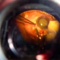 How Medical Imaging Is Revolutionizing Eye Surgery In Cape Coral
