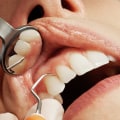 Exploring The Process Of Veneers For Tooth In Conroe, TX With The Help Of Medical Imaging
