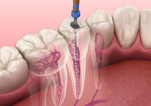 How Medical Imaging Enhances Root Canal Treatments In San Antonio