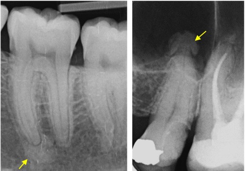 How Medical Imaging Enhances Root Canal Treatments In San Antonio