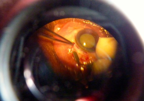 How Medical Imaging Is Revolutionizing Eye Surgery In Cape Coral