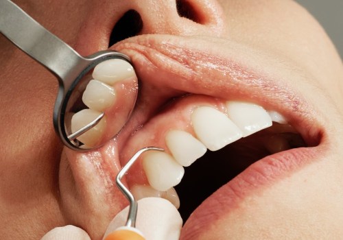 Exploring The Process Of Veneers For Tooth In Conroe, TX With The Help Of Medical Imaging